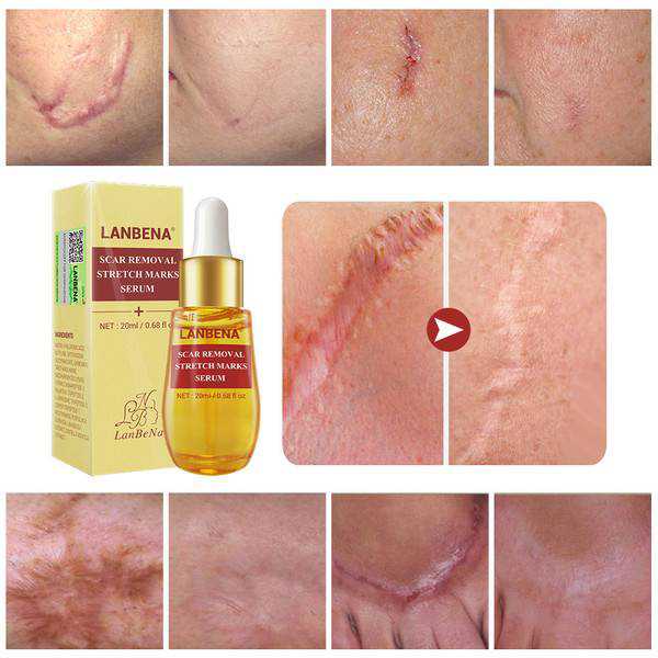 LANBENA Acne Scar Remove Serum Acne Treatment Remover Stretch Marks Anti Acne Shrink Pores Blackhead Whitening Cream Skin Care