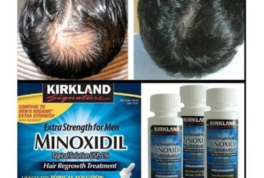 Minoxidil Hair Growth Oil For Men
