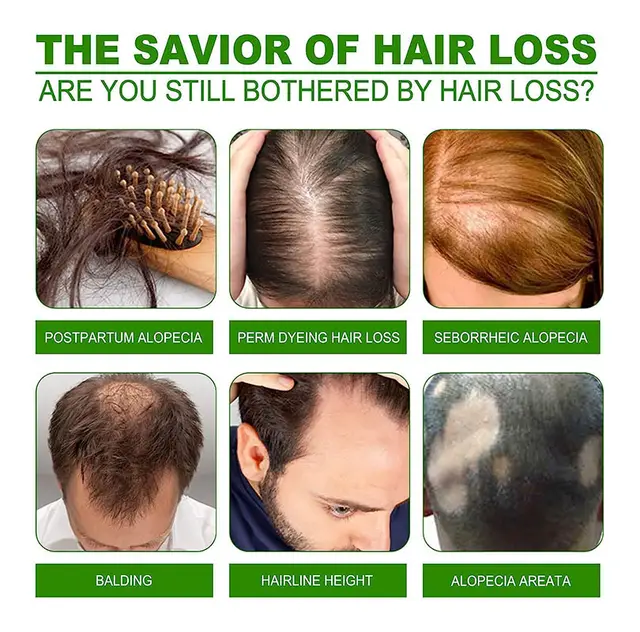Neo Hair Lotion 120ml Green Wealth Scalp Treatment Stop Hair Loss Root Nutrients hair growth serum